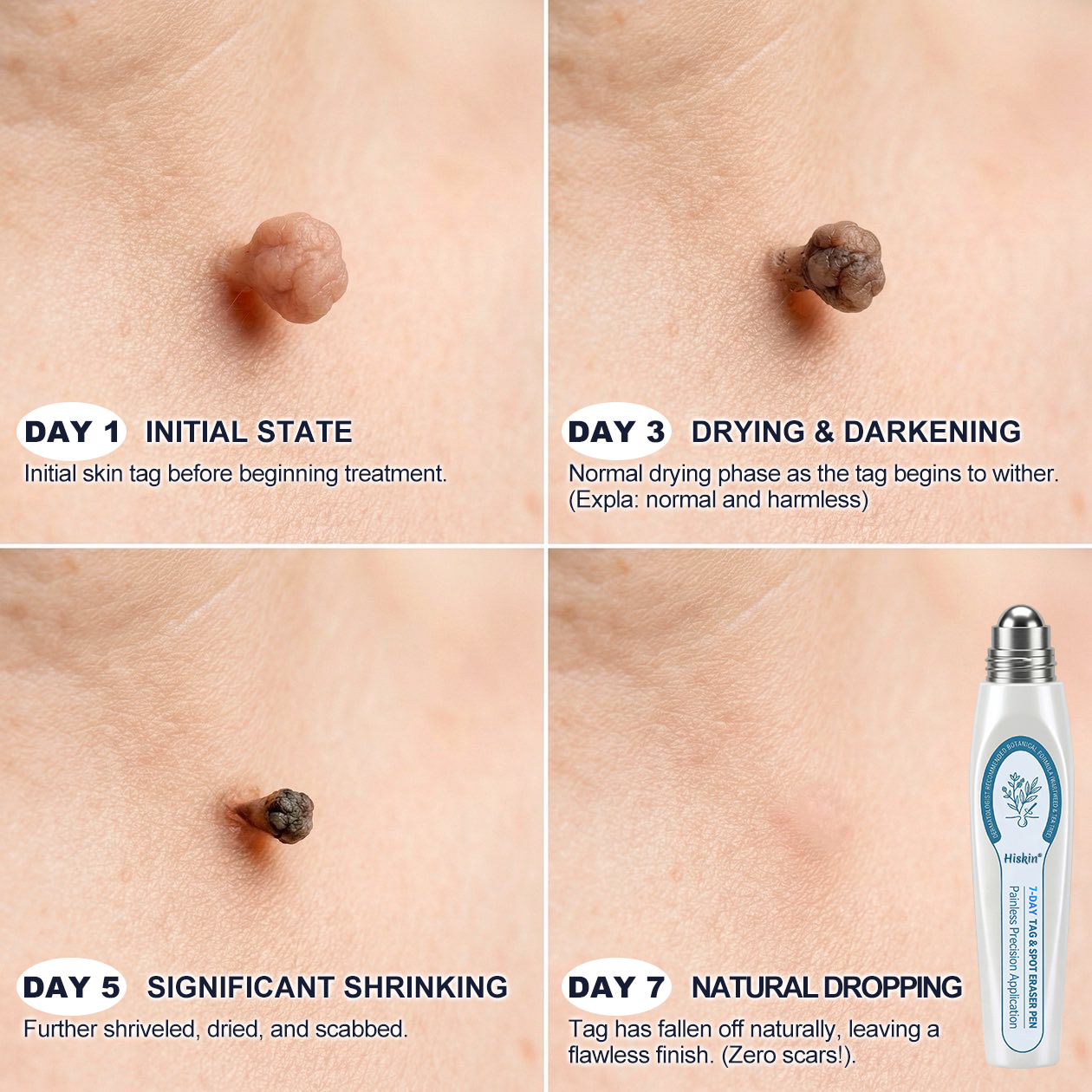 💯Skin Tag & Dark Spot Care Pen - Precision Care Without the Mess