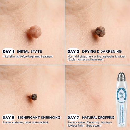 💯Skin Tag & Dark Spot Care Pen - Precision Care Without the Mess