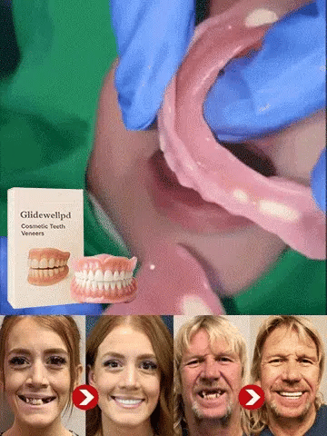 🦷【 Epic Upgrade】Premium Full Cover Dentures 🦷