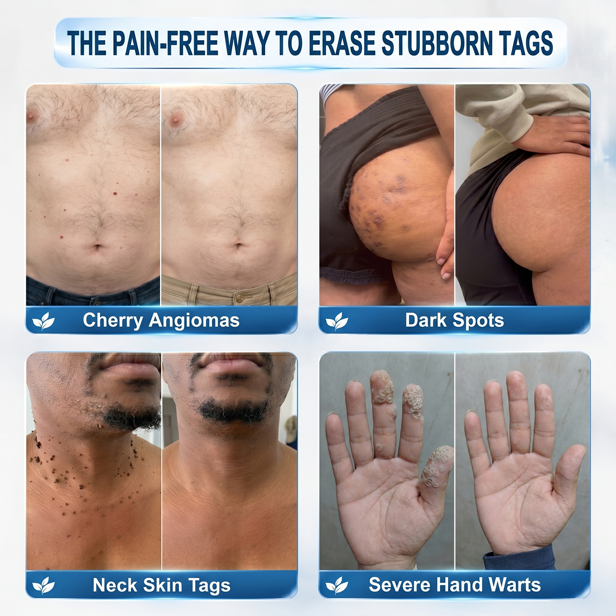 💯Skin Tag & Dark Spot Care Pen - Precision Care Without the Mess