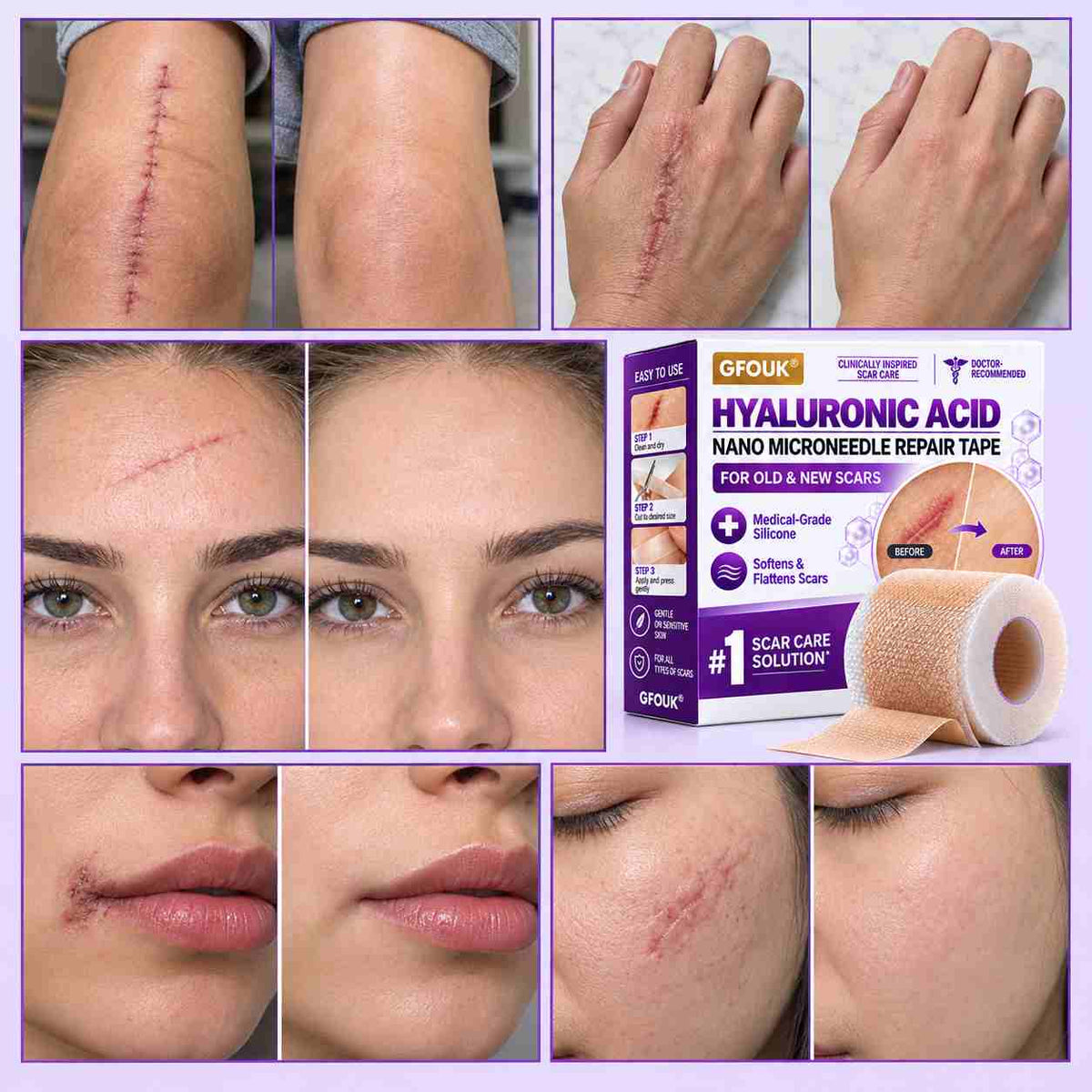 ✅GFOUK® Hyaluronic Acid Nano Microneedle Repair Tape🦘👨‍⚕️