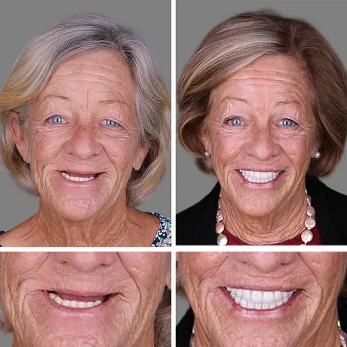 🦷 Ends Today: 50% OFF! ⏰ Medical Full Denture with Strong Suction