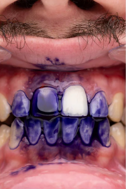 PURPLE V34 - Teeth Whitening