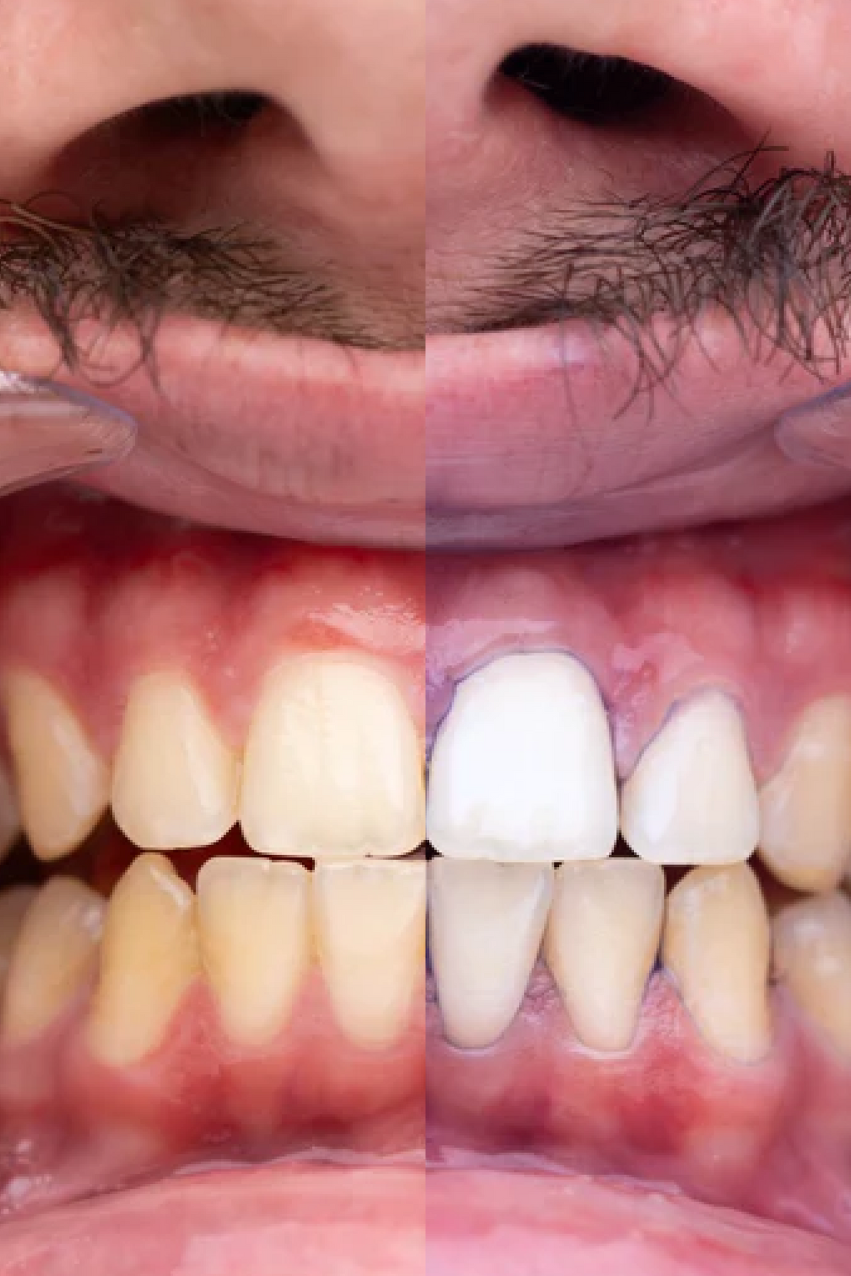 PURPLE V34 - Teeth Whitening