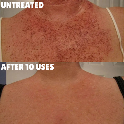 Cellular-Level Delivery Triple Acid Complex For Hyperpigmentation