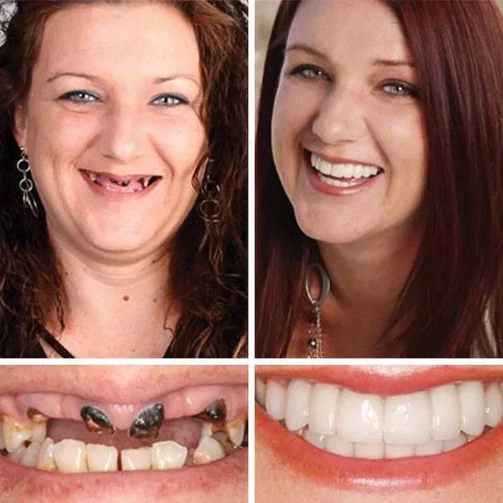 🦷 Ends Today: 50% OFF! ⏰ Medical Full Denture with Strong Suction