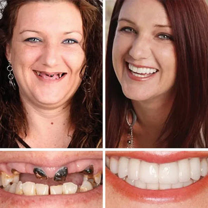 🦷 Ends Today: 50% OFF! ⏰ Medical Full Denture with Strong Suction