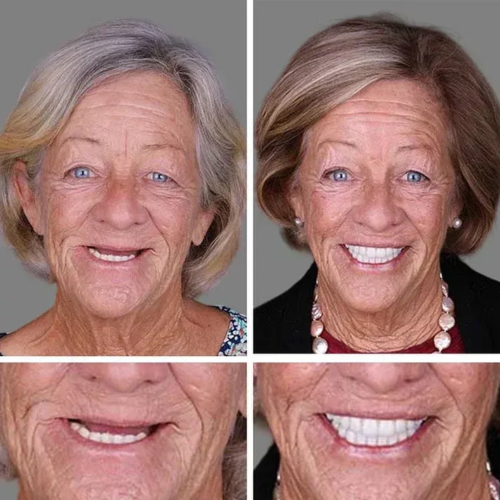 🌎 Ends Today: 50% OFF! ⏰ Medical Full Denture with Strong Suction