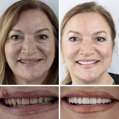 🌎 Ends Today: 50% OFF! ⏰ Medical Full Denture with Strong Suction