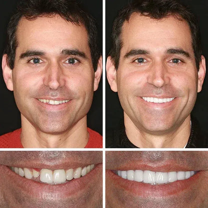🌎 Ends Today: 50% OFF! ⏰ Medical Full Denture with Strong Suction